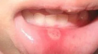 سبب ظهور الحبوب داخل الفم