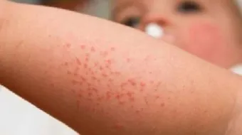 سبب ظهور حبوب حمراء عند الأطفال