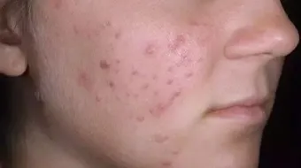 سبب ظهور حبوب صغيره في الوجه