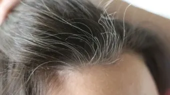 سبب ظهور الشعر الأبيض