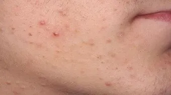 سبب ظهور الحبوب فجأة في الوجه