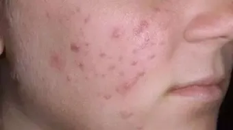 أسباب ظهور الحبوب على الوجه وعلاجها