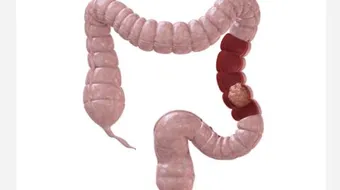 مخاطر وجود الدم في البراز