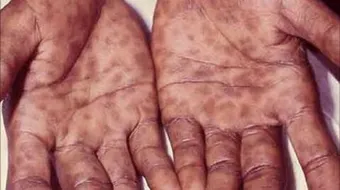 المرحلة الثانية من مرض الزهري