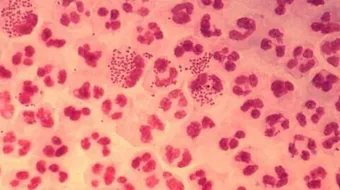 المرحلة الثالثة من مرض الزهري