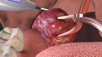 عملية إزالة اللوزتين