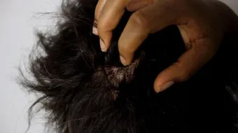 الحل النهائي للقمل