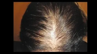 طرق تكثيف الشعر الخفيف