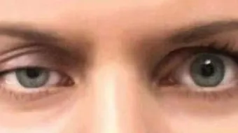 الغدة الدرقية وأمراض العين