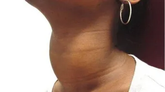 فوائد الغدة الدرقية