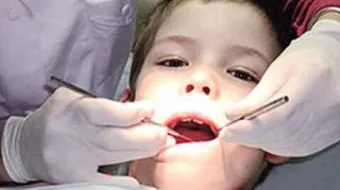 نصائح بعد خلع الضرس