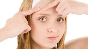 علاج حب الشباب الموضعي - فيديو