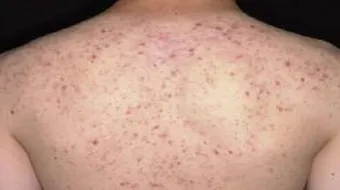 علاج حب الشباب في الظهر والصدر