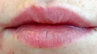 علاج جفاف الشفاه