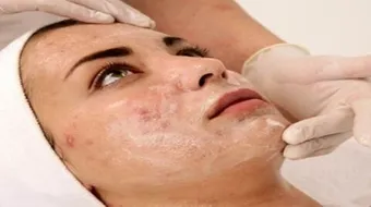 علاج بثور الوجه