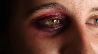 علاج كدمات الوجه