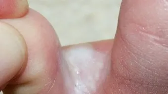 علاج الفطريات بين أصابع القدمين