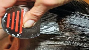 علاج حشرات الشعر