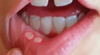 علاج تقرحات الفم