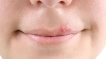 علاج الحبوب حول الفم