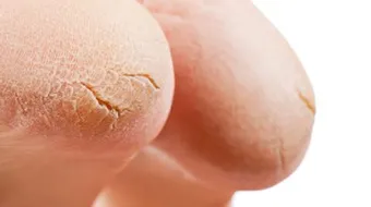 علاج خشونة القدمين بالأعشاب