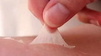 علاج الحروق من الدرجة الثانية