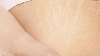 علاج تشققات الجلد