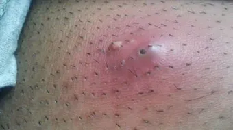 علاج نمو الشعر تحت الجلد بالأعشاب