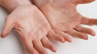 علاج تعرق اليدين والرجلين