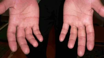 علاج تعرق اليدين