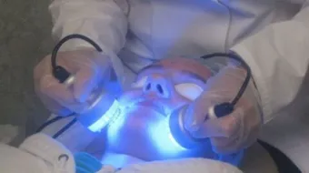 معالجة آثار حب الشباب