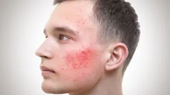 علاج آثار حب الشباب للبشرة الدهنية