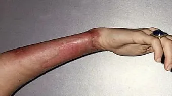 علاج آثار الحروق القديمة