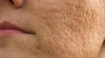 علاج آثار الحبوب في الوجه