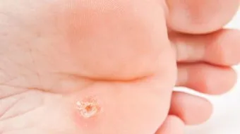 علاج ثآليل القدم