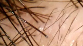 علاج ضعف بصيلات الشعر