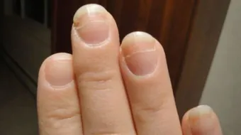 علاج ضعف الأظافر