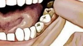 علاج ألم ضرس العقل