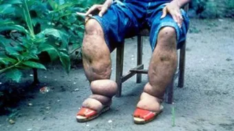 علاج داء الفيل