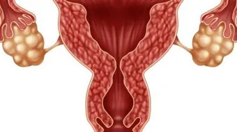علاج تضخم بطانة الرحم