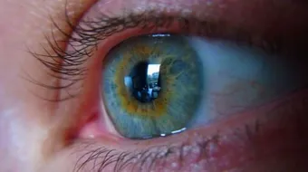 علاج ضغط العين المرتفع