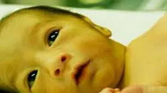 علاج مرض اليرقان