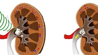علاج حصوات الكلى و الأملاح