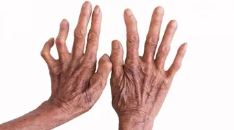 علاج مرض الجذام