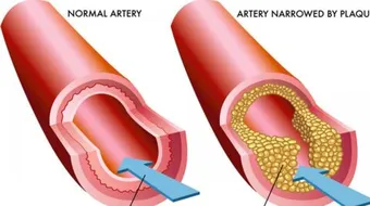 علاج ضيق الشرايين