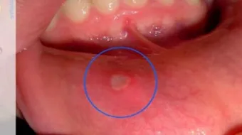 علاج فطريات الفم للأطفال