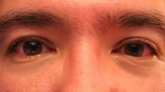 علاج الرمد الربيعي