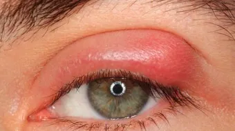 علاج انتفاخ جفن العين العلوي