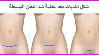 شد البطن بعد الولادة القيصرية
