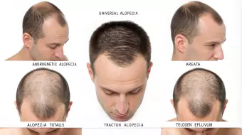 أنواع الثعلبة